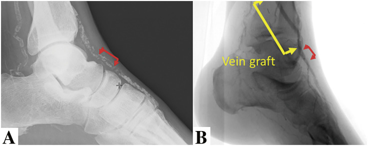 Infrapopliteal Surgical and Endovascular Intervention.