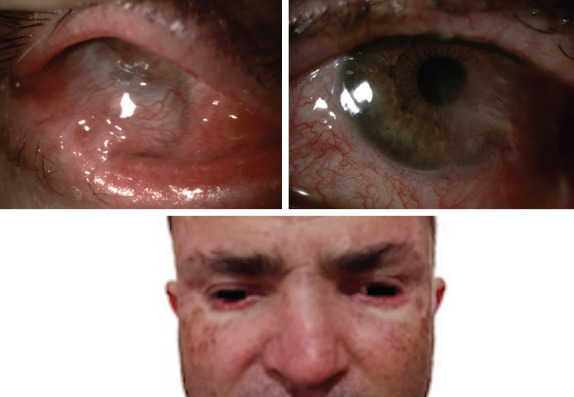 Foveal Hypoplasia in Presumed Xeroderma Pigmentosum: A Case Report.