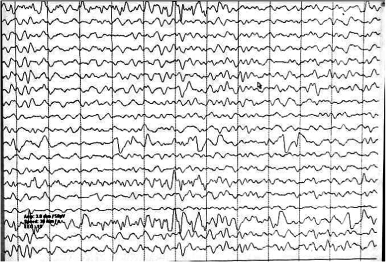 Unveiling post-COVID-19 Rasmussen's encephalitis: a case report of rare neurological complication.