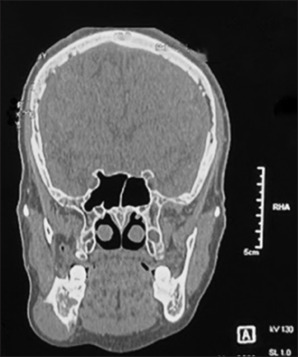 Mandibular lateral ectopia: A rare case presentation.