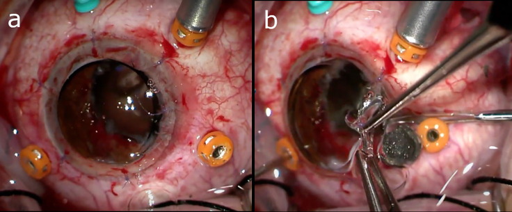 Advances in the management of intraocular foreign bodies.