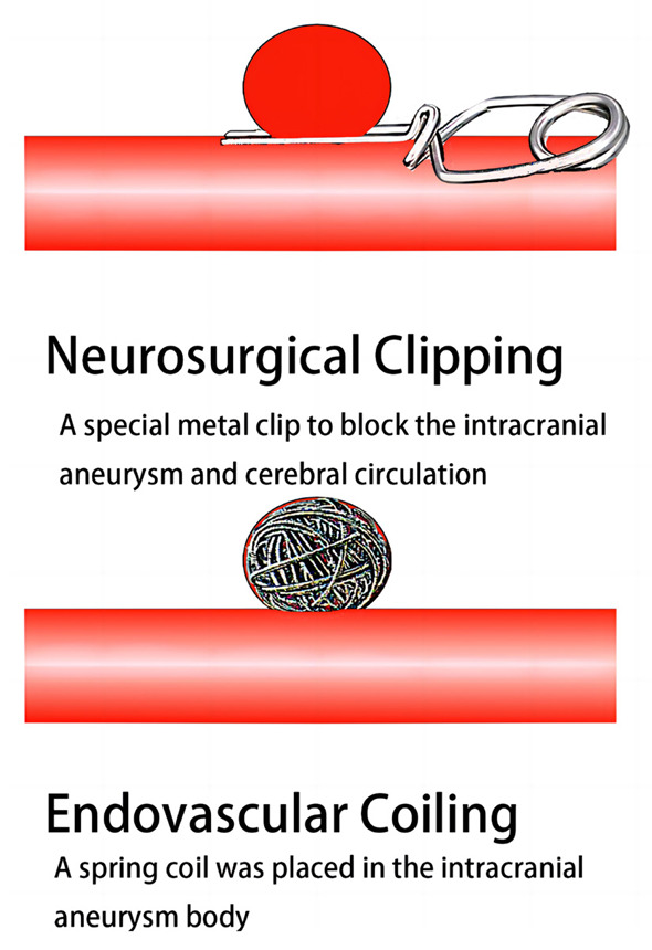 Endovascular treatment of intracranial aneurysms: Past and present.