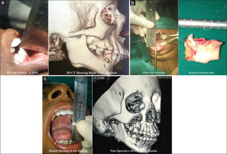 Assessment of the role of coronoid in restrictive jaw disorders and physiologic mandibular movements.