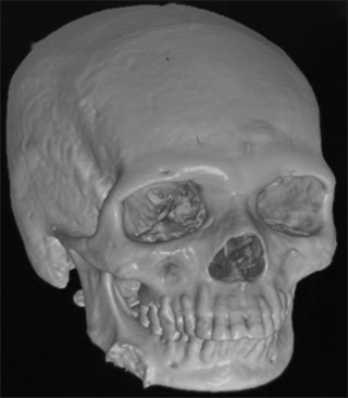 Mandibular lateral ectopia: A rare case presentation.
