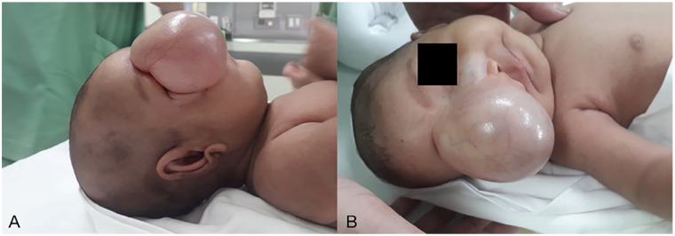 Unusual Case of Fetal Meningocele Mimicking Dacryocystocele.