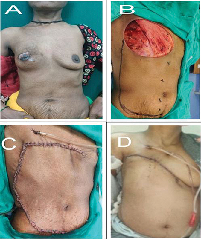 Medially Based "Abdominal Rotation Advancement Flap": A Promising Technique for Mastectomy Defect Reconstruction in "High-Risk Patients" Awaiting Adjuvant Radiotherapy.