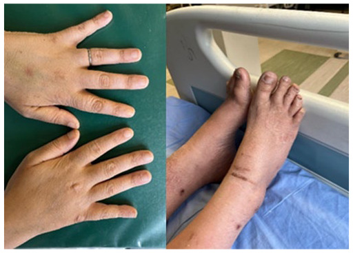 Myxedema ascites? A rare presentation of ascites in severe hypothyroidism: A case report and review.