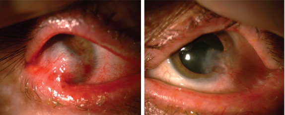 Foveal Hypoplasia in Presumed Xeroderma Pigmentosum: A Case Report.