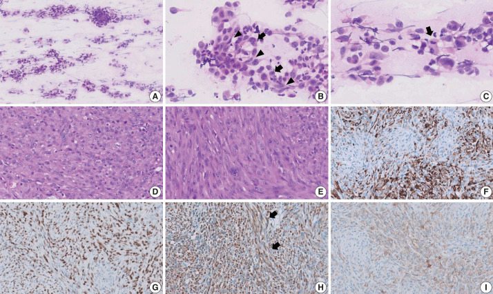 Rhabdomyosarcoma of the skull with EWSR1 fusion and ALK and cytokeratin expression: a case report.