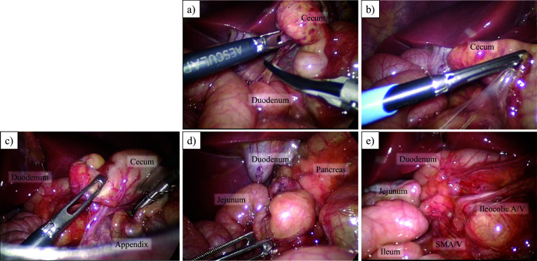 A case of isolated malrotation without midgut volvulus diagnosed prenatally and treated by laparoscopic surgery.