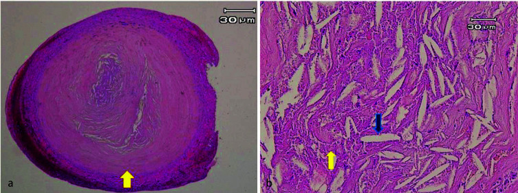 Cholesterol Granuloma of the Lower Lip: Report of a Rare Case.