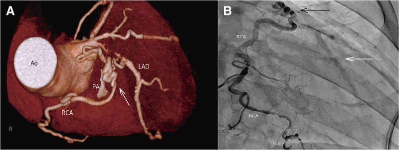 Coronary-Pulmonary Artery Fistula Provides Collateral Flow to an Occluded Left Anterior Descending Artery.