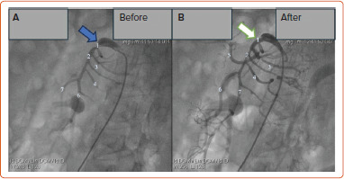 Endovascular Intervention for Acute Superior Mesenteric Artery Occlusion Following COVID-19 Pneumonia: Two Case Reports.