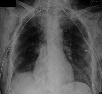 Endotracheal Oxygen Insufflation Associated with Life-Threatening Barotrauma during Apnea Testing.