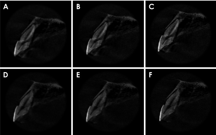 Combination of metal artifact reduction and sharpening filter application for horizontal root fracture diagnosis in teeth adjacent to a zirconia implant.