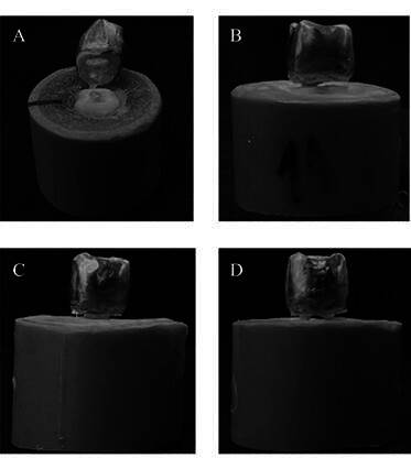 Exploring fiberglass post numbers for enhanced fatigue resistance in molars without coronary remnants.