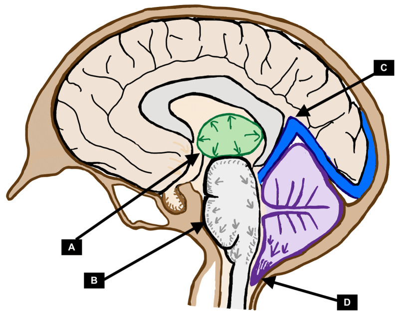 Movement Disorders in Brain Sagging Syndrome Due To Spontaneous Intracranial Hypotension: A Review.