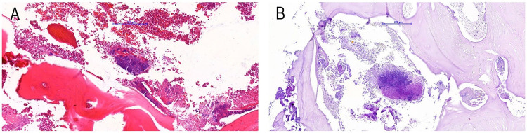 Secukinumab Causing Medication-Related Osteonecrosis of the Jaw, in a Patient Diagnosed with Psoriasis and Rheumatoid Arthritis.