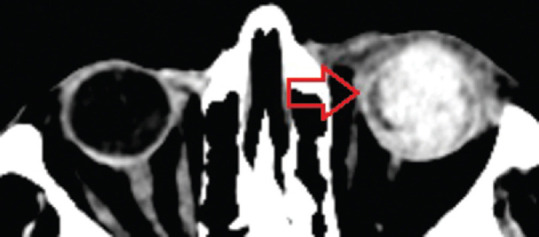 "Don't miss the globe" - Study of diagnostic accuracy of computed tomography in detecting open globe injury.