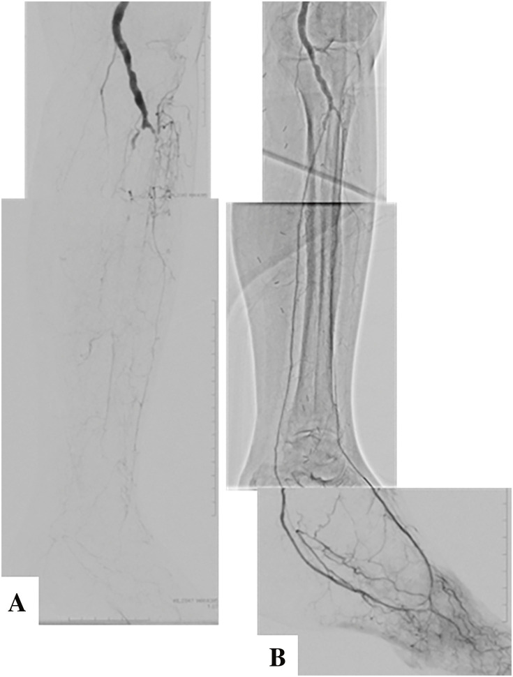 Infrapopliteal Surgical and Endovascular Intervention.