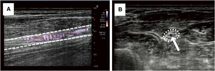 Ultrasonographic Study of the Corkscrew Arterial Image in Buerger Disease Patients.