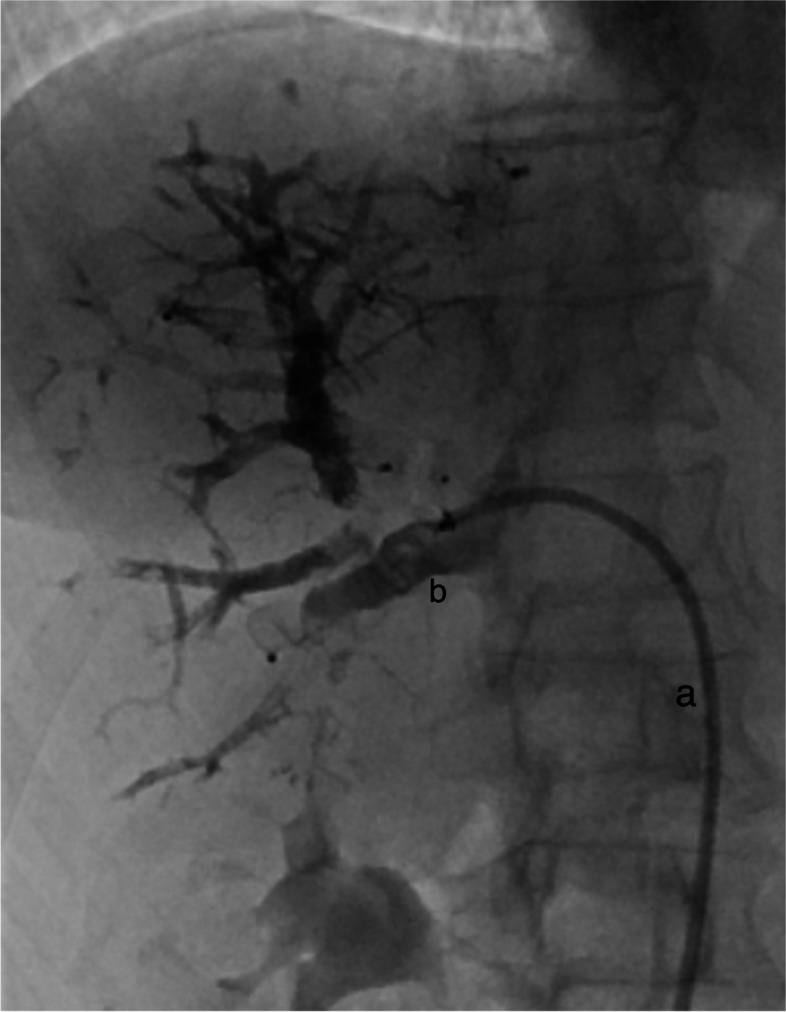 Transfemoral hepatic vein access in double vein embolization - initial experience and feasibility.