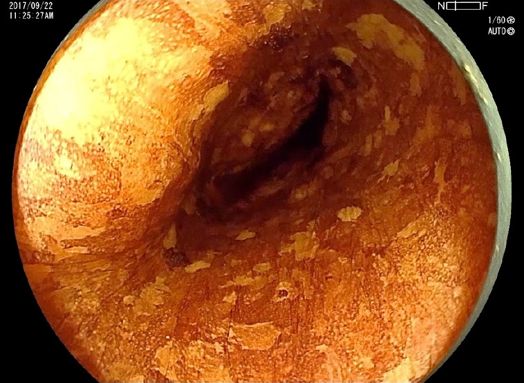 Surveillance for metachronous cancers after endoscopic resection of esophageal squamous cell carcinoma.