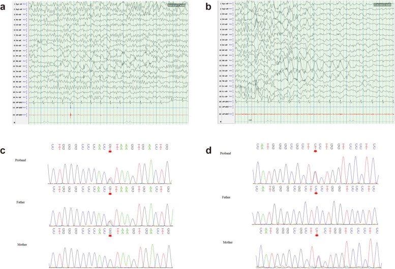 Identification of autosomal dominant lateral temporal epilepsy caused by a novel mutation in RELN in China: a case report.