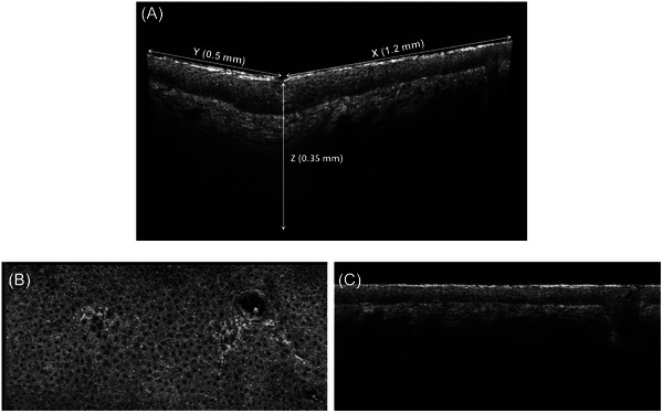 Comparison of facial skin ageing in healthy Asian and Caucasian females quantified by in vivo line-field confocal optical coherence tomography 3D imaging.
