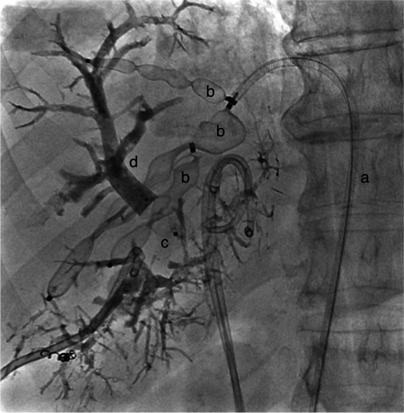 Transfemoral hepatic vein access in double vein embolization - initial experience and feasibility.