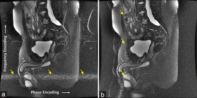 Radiofrequency interference in magnetic resonance imaging: Identification and rectification.