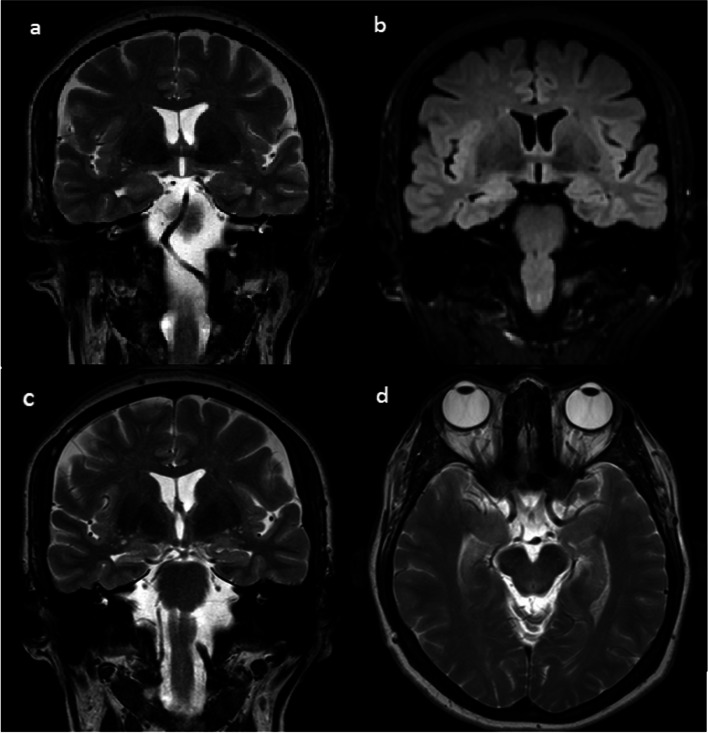 Mesial temporal sclerosis and epilepsy: a narrative review.