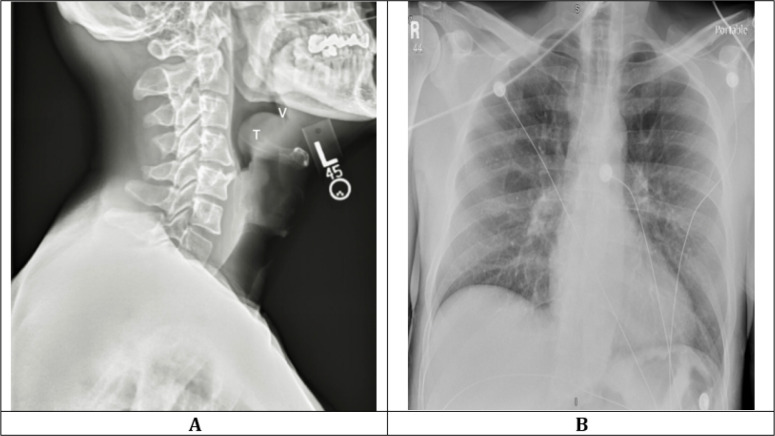 Adult Epiglottitis as an Often Overlooked, Life-threatening Condition Requiring Special Airway Consideration; a Case Report.
