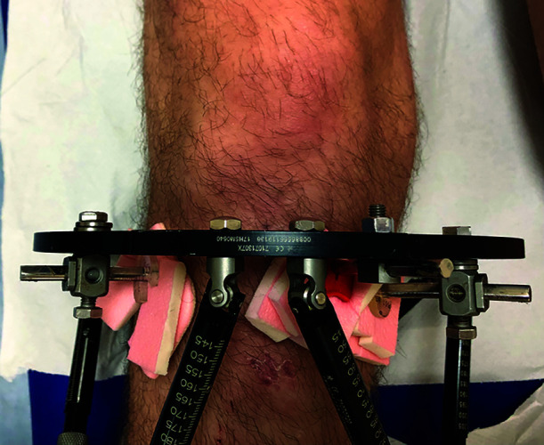Technical Article: Short-segment Placement of Proximal Tibial Half-pins.