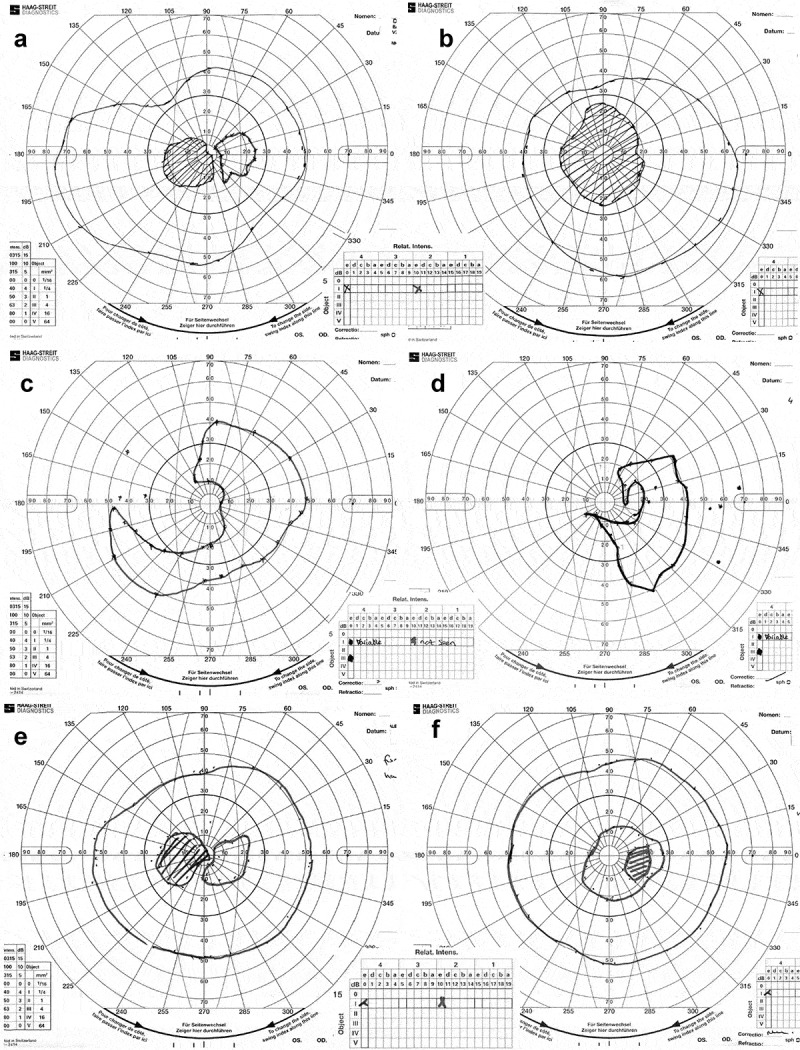 Adult-Onset Bilateral Optic Neuropathy in a Patient with Non-Familial Childhood-Onset Generalized Dystonia Associated with Mitochondrial DNA 14459G>A Mutation: A Case Report and Review of Literature.