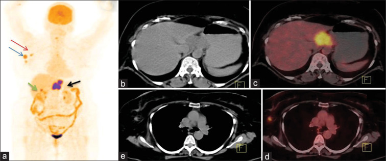 Utility of [18F]FDG- PET/CT in Initial Staging and Management of Patients with Esophageal Carcinoma: A Tertiary Care Center Experience.