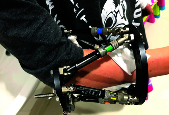 Indirect Hexapod Frame-assisted Reduction of Chronic Radial Head Dislocations in Children: 20-year Experience and Technical Tips.