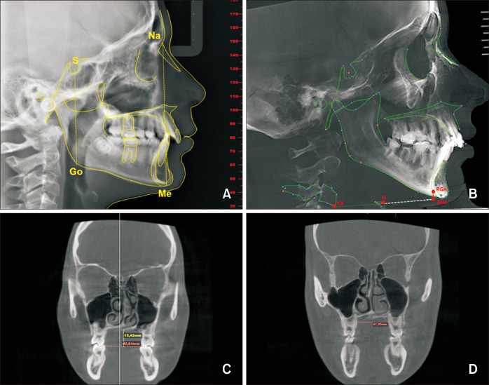 Upper airway dimensions and craniofacial morphology: A correlation study using cone beam computed tomography.