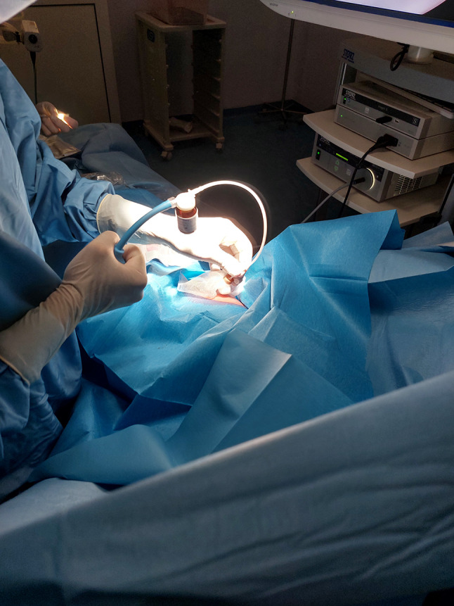 The Role of Medical Thoracoscopy with Talc Poudrage in Spontaneous, Iatrogenic, and Traumatic Pneumothorax: A Prolonged Experience of a Tertiary Care Center.