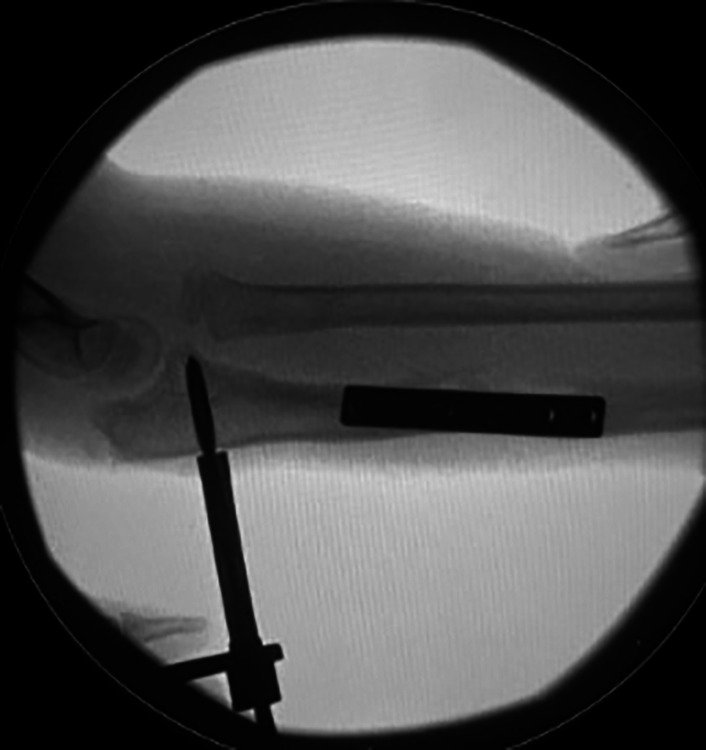 Indirect Hexapod Frame-assisted Reduction of Chronic Radial Head Dislocations in Children: 20-year Experience and Technical Tips.