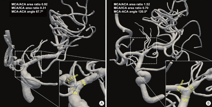 Geometry of Terminal Internal Carotid Artery Bifurcation May Be Associated With Middle Cerebral Artery Plaque Ulceration: A Three-Dimensional Rotational Angiography Study.