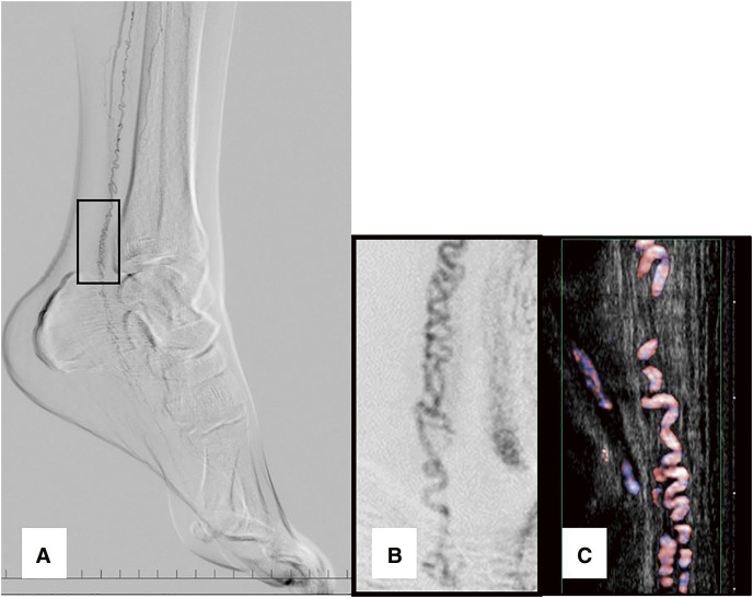 Ultrasonographic Study of the Corkscrew Arterial Image in Buerger Disease Patients.