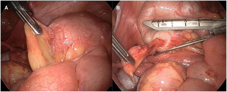 Appendiceal intussusception due to endometriosis presenting as acute right lower quadrant pain.