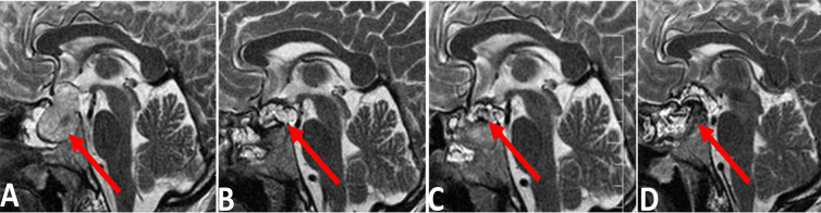The Optimal Time for Postoperative Magnetic Resonance Imaging of the Sella in Patients With Pituitary Adenoma.