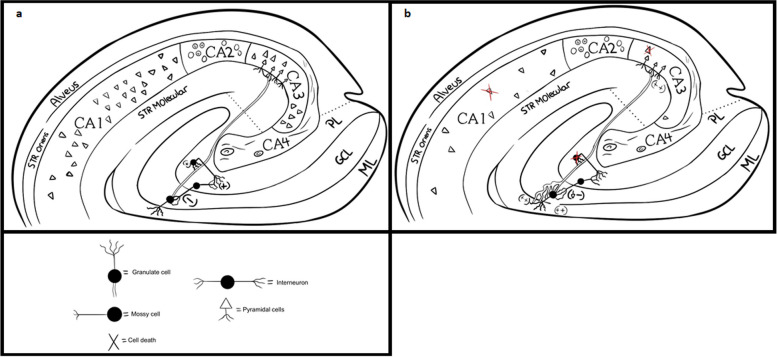 Mesial temporal sclerosis and epilepsy: a narrative review.