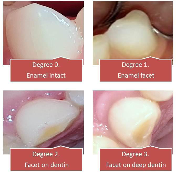 Primary tooth wear in children from different social environments.