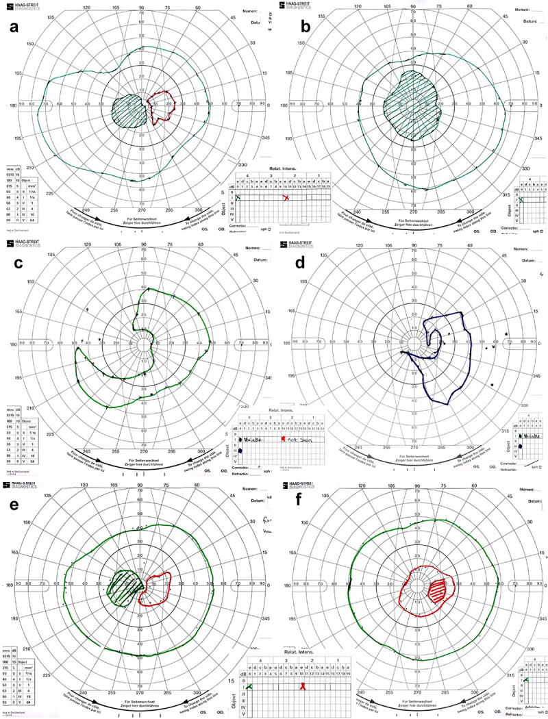 Adult-Onset Bilateral Optic Neuropathy in a Patient with Non-Familial Childhood-Onset Generalized Dystonia Associated with Mitochondrial DNA 14459G>A Mutation: A Case Report and Review of Literature.