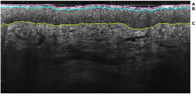 Comparison of facial skin ageing in healthy Asian and Caucasian females quantified by in vivo line-field confocal optical coherence tomography 3D imaging.