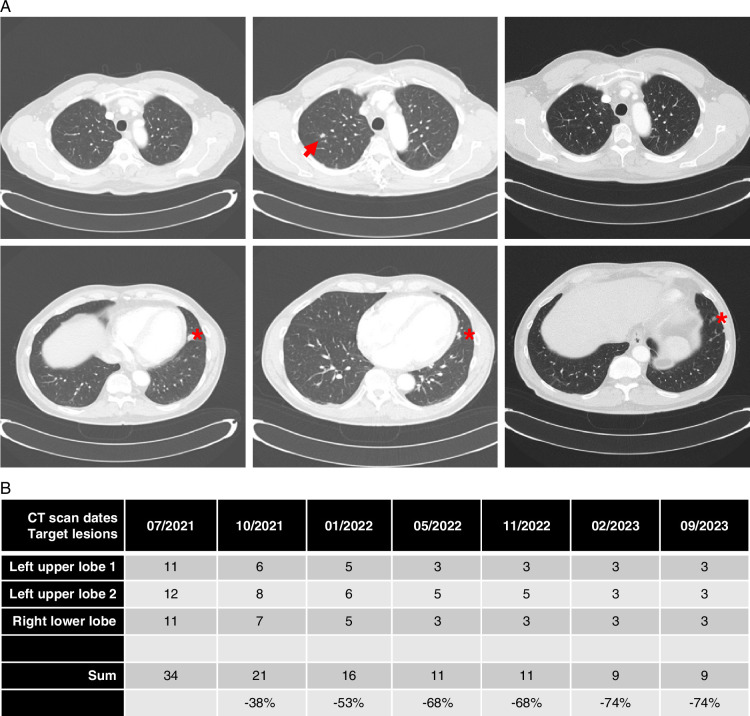 Nivolumab as a Promising Treatment Option for Metastatic Salivary Duct Carcinoma.