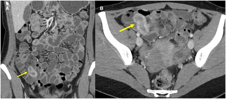Appendiceal intussusception due to endometriosis presenting as acute right lower quadrant pain.